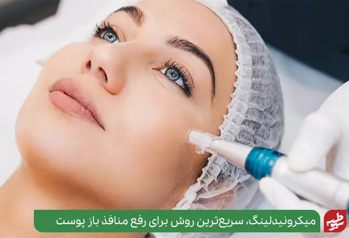 بستن دائم منافذ پوست با میکرونیدلینگ|سیوطب