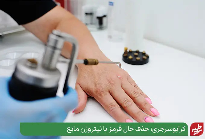 کرایوسرجری برای حذف خال قرمز گوشتی|سیوطب