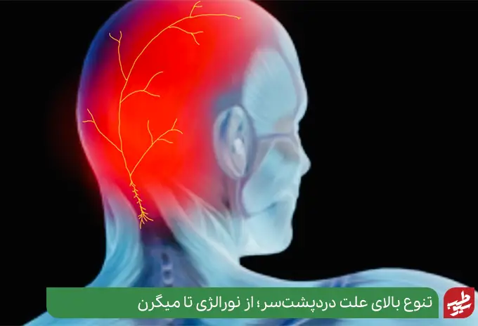 درد پشت سر نشانه چیست به دلیل التهاب اعصاب در پشت سر|سیوطب