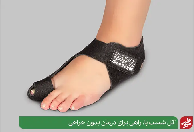 آتل شست پا موثر در تسکین و درمان درد انحراف انگشت پا | سیوطب