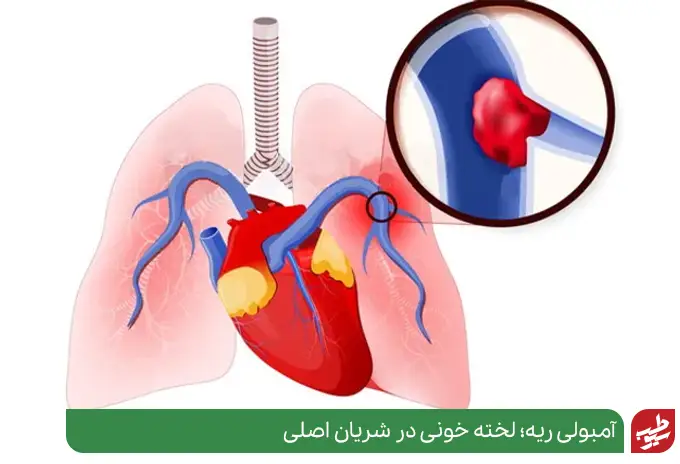 آمبولی ریه علتی برای ایجاد سوزش قفسه سینه|سیوطب