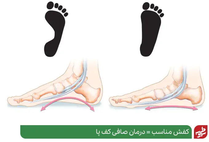 آناتومی پا که دچار صافی کف است و نیاز به کفش مناسب برای صافی کف پا دارد|سیوطب