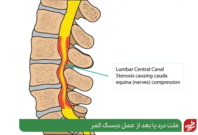 تنگی کانال نخاعی مهره‌های کمر علت درد پا بعد از عمل دیسک کمر|سیوطب