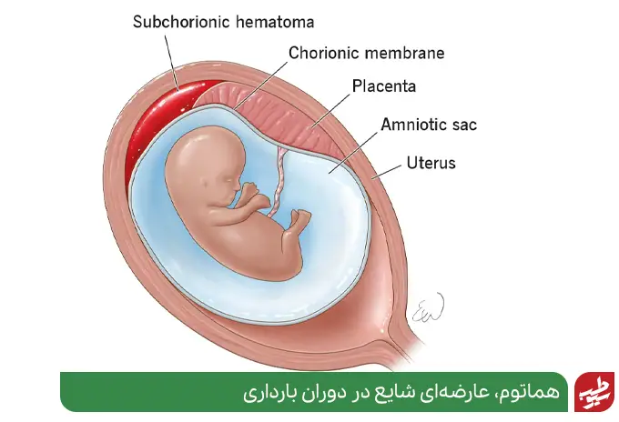 هماتوم چیست و بارداری | سیوطب
