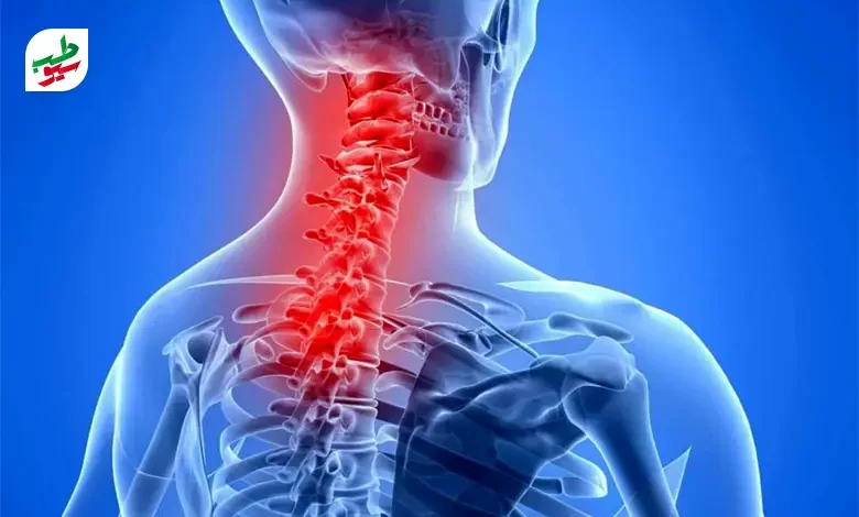 بیرون زدگی مهره گردن باعث درد در گردن و شانه می‌شود|سیوطب