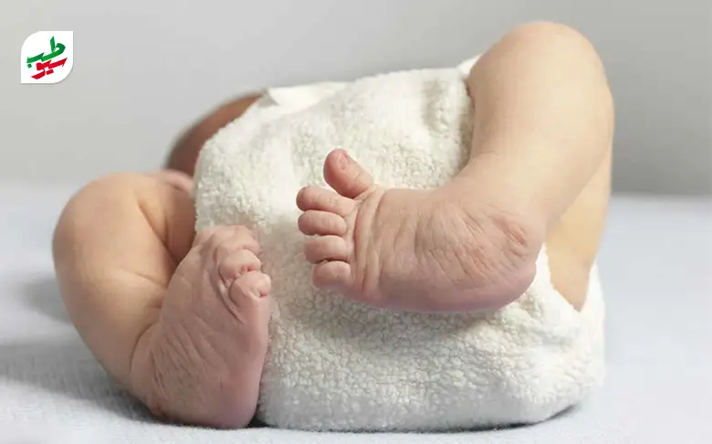 پای پرانتزی نوزاد که نیاز به درمان دارد|سیوطب