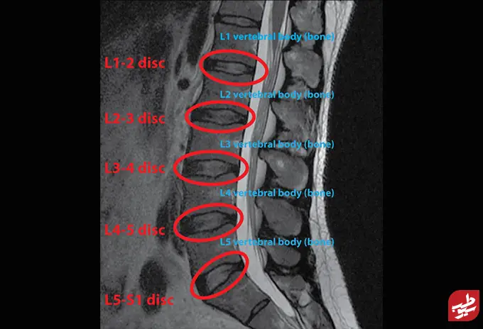 تصویر مهره‌های کمر با MRI و روش خواندن عکس ام ار ای از دیسک کمر|سیوطب