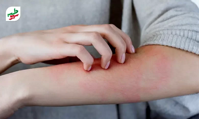 فردی مبتلا به حساسیت پوستی|سیوطب
