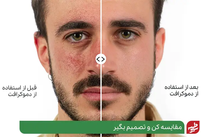 قبل و بعد صورت با دستگاه نور درمانی صورت|سیوطب