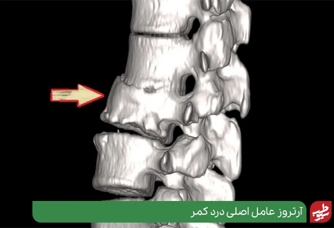آرتروز عامل اصلی درد بالای لگن سمت چپ در ستون فقرات|سیوطب