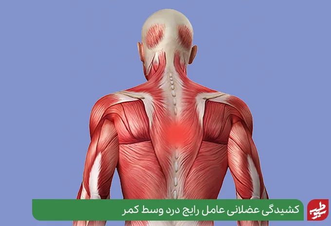 آسیب‌های عضلانی مانند کشیدگی یا رگ به رگ شدن علت درد وسط پشت|سیوطب