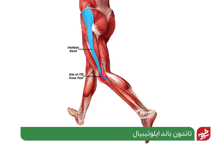 آسیب به کدام اجزای زانو منجر به زانو درد پس از ورزش می شود|سیوطب