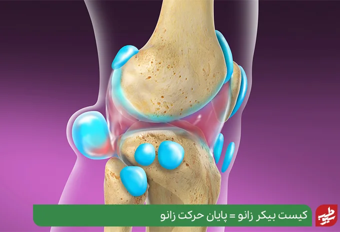 کیست بیکر (کیست پوپلیتئال) علت درد پشت زانو هنگام خم شدن| سیو طب