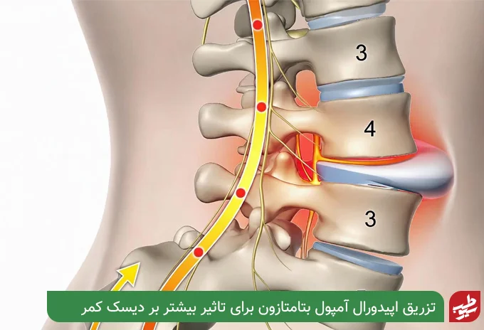 آمپول بتامتازون برای دیسک کمر | سیو طب